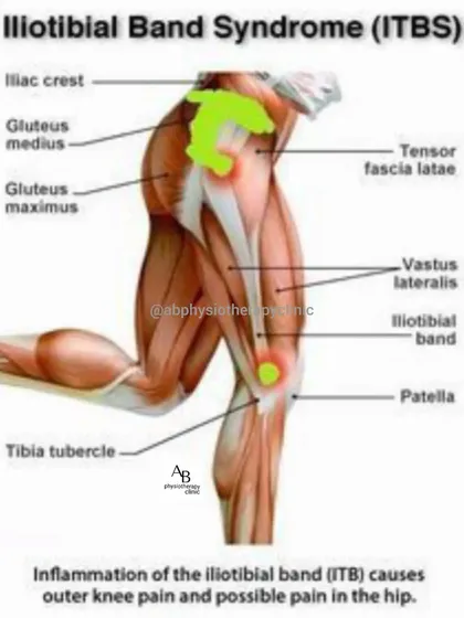 Iliotibial (IT) Band Syndrome is a common cause of outer knee pain, especially in runners. Our treatment focuses on releasing the tight band and strengthening the hip muscles to correct the underlying mechanics.