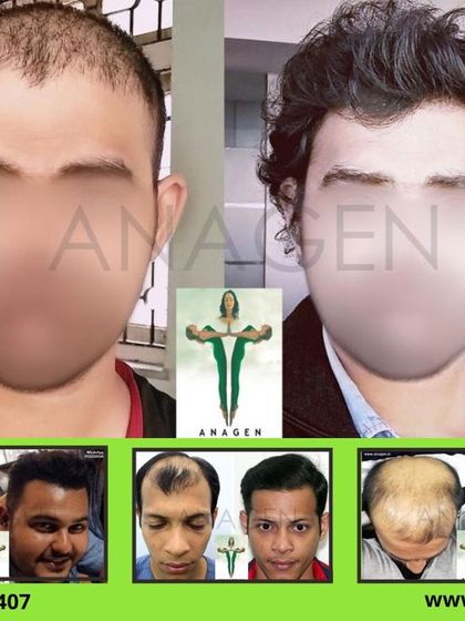 A collage showing multiple high density results from our Biotech Instant Direct Pen FUE technique. We specialize in creating excellent, natural hairlines.