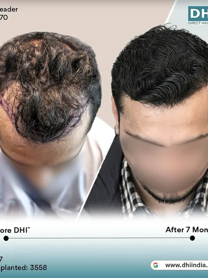 A top-down view of a 27-year-old client 7 months after his procedure. With 3,558 hairs implanted, the transformation in density and coverage is already outstanding.