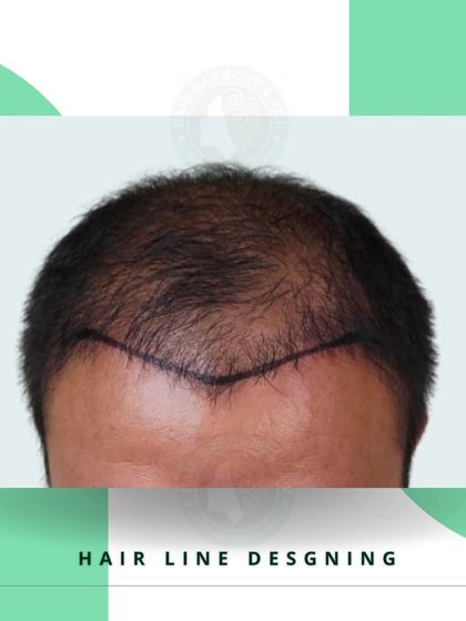 Here is another example of a carefully designed hairline. The markings guide the placement of each graft to ensure the final result looks completely natural and not like a transplant.