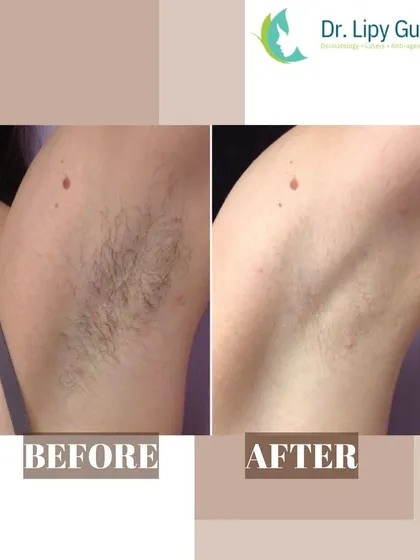 This before and after image shows the significant reduction of underarm hair after a course of laser treatments. The result is smooth, clear skin, free from the dark shadow of hair, irritation, and ingrown hairs often caused by shaving.