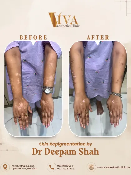 Restoring skin color for vitiligo patients is a gradual but rewarding process. This before and after shows the repigmentation journey on the hands and arms. With consistent, medically-guided treatment, we can achieve visible and lasting improvements.