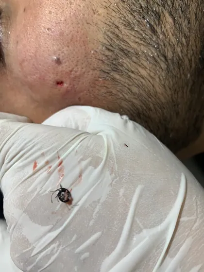 A close-up view of a successful ingrown hair clump removal. This common and often painful issue can be resolved with a precise in-clinic procedure, preventing further inflammation and potential scarring that can result from improper hair removal techniques.