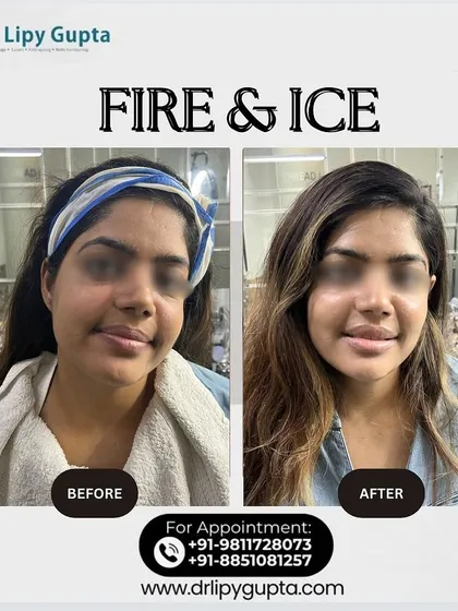 A fantastic before and after result from the Fire & Ice facial. You can clearly see the improvement in skin brightness and the reduction in dullness. The after photo shows a healthy, hydrated glow, which is exactly what this treatment is designed to deliver.