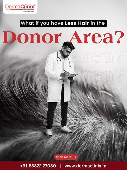 What if you have less hair in the donor area? This is a common concern, but with advanced techniques, it is not always a barrier to a successful transplant.