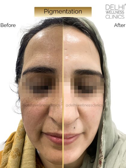 This split-face before and after shows a remarkable improvement in facial pigmentation, revealing clearer and more radiant skin.