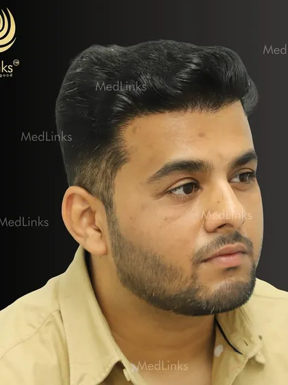 The final result of a successful hair transplant. Notice the natural density and the way the hair can be styled. We don't just add hair; we restore a look that is youthful and full of life.