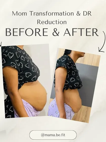 This before and after shot highlights the reduction of the "mommy pooch." This is not just about aesthetics; it's about rebuilding core function and strength from the inside out.