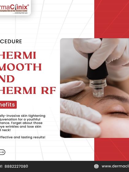 An image of a ThermiSmooth RF treatment. This minimally invasive procedure tightens skin and rejuvenates your appearance, effectively treating under-eye wrinkles and loose skin around the neck.