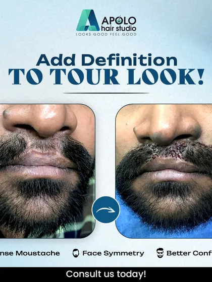 A moustache can define your entire look, and we help clients achieve that. This comparison shows how we performed a moustache transplant to create a dense, symmetrical, and full moustache, significantly improving facial symmetry and confidence.