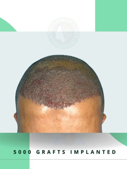 A close-up view of 5000 implanted grafts. This demonstrates the level of density that can be achieved in a single session to cover a large area of baldness.