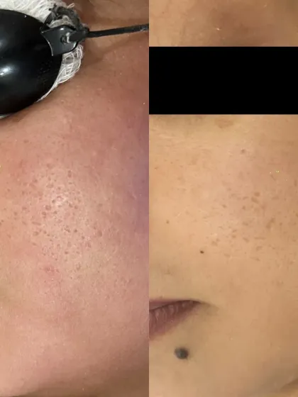 This client's concern was open pores and uneven skin texture. This split image shows the visible refinement in skin texture and pore size after a targeted laser treatment, resulting in a smoother surface.