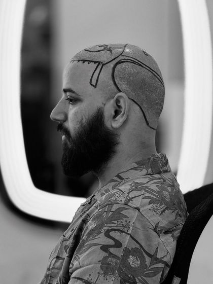 A black and white shot of a patient, adding an artistic touch to the pre-transplant process. Our clinic is not just about medical procedures, it's about creating a new you.