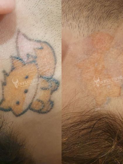 Our Pico laser is effective on colored tattoos as well. This image shows the significant fading of an orange and black ink tattoo, demonstrating the versatility of the technology.