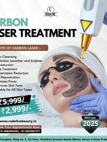 This graphic details a special offer for our Carbon Laser Treatment. It lists the many benefits, including deep cleansing, oil reduction, minimizing pores, and improving skin tone, making it suitable for all skin types.