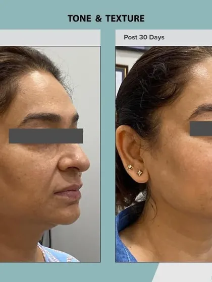 This patient's results after 30 days of AdvaTx treatment show a marked improvement in overall skin tone and texture. The skin appears smoother, firmer, and more radiant.