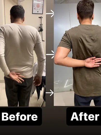 Before and After: Mr. Deepak, age 37, showing his limited back-reach before treatment and the remarkable improvement after just 20 days of physiotherapy for his frozen shoulder.