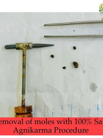 This image displays the Agnikarma tool alongside the moles that were safely and effectively removed during the procedure.