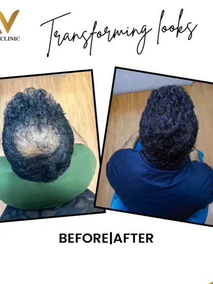 This client's main concern was the balding patch on his crown. We focused on achieving high density in this area, resulting in a completely natural and full look from behind.