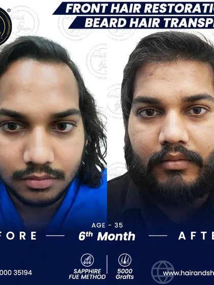 It's not just about scalp hair. We also specialize in creating full, well-defined beards. This patient's 6-month transformation using the Sapphire FUE method shows how we can fill in gaps and craft a beard that perfectly frames the face.