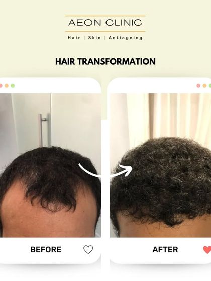 This before-and-after comparison clearly shows the successful restoration of a client's hair, resulting in a much fuller and healthier appearance.