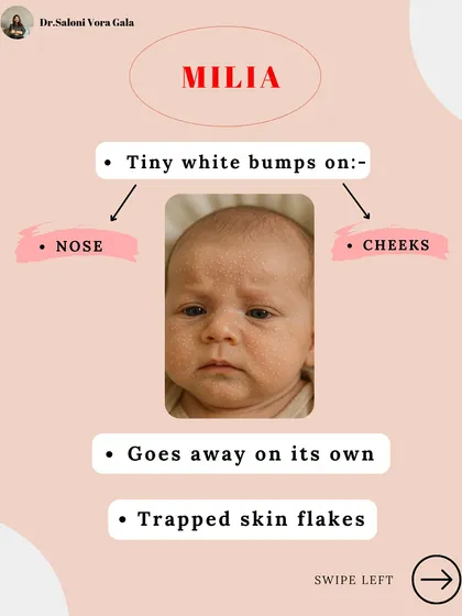 Milia in babies are tiny white bumps on the nose and cheeks caused by trapped skin flakes. They are very common and typically go away on their own without any treatment.