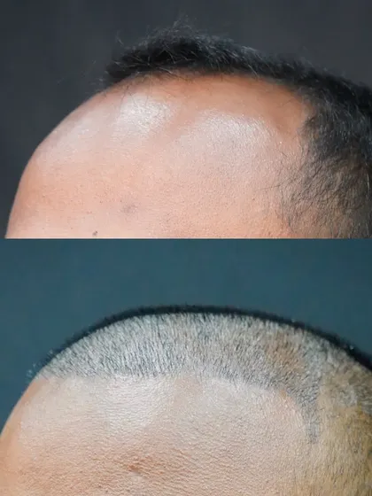 This before-and-after image shows the result just 10 days after a 4300-graft FUE procedure. You can see the newly designed, denser hairline that will frame the face and create a more youthful appearance.