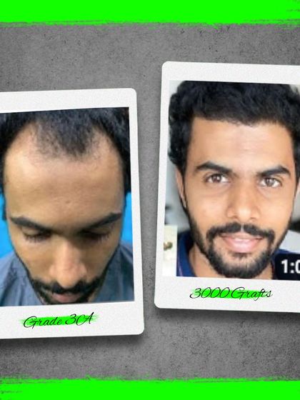 This patient with Grade 3A baldness received 3000 grafts. The after photo shows a remarkable improvement in density and a well designed, natural looking hairline.