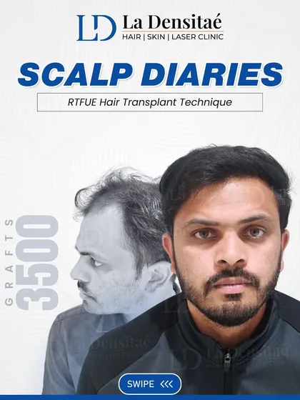 Uddhav’s journey was about getting back what hair loss took away. With 3,500 grafts using my RT-FUE technique, his hairline now feels natural again, and the density finally matches his age, not his struggle.