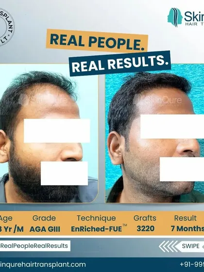 A frontal view of the 28-year-old patient's transformation. The before and after comparison clearly shows the restored hairline and increased density, which has significantly improved his facial framing.