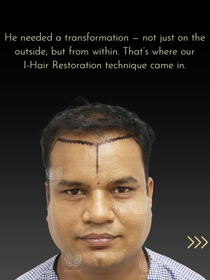 Kamlesh needed a transformation from the inside out. Our advanced I-Hair Restoration technique was the perfect solution, starting with the meticulous design of a new hairline that would frame his face naturally.