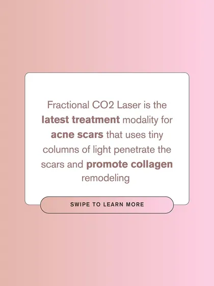 The Fractional CO2 laser is the latest treatment modality for acne scars. It uses tiny columns of light to penetrate scars and promote collagen remodeling for smoother skin.