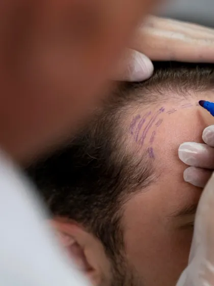 Precision is the foundation of a successful hair transplant. Here, I am carefully marking the new hairline for a client before a Follicular Unit Extraction (FUE) procedure. This planning stage is crucial to ensure the final result looks completely natural and complements your features.