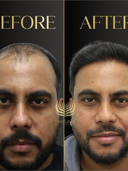 This before and after comparison shows a complete transformation. The patient looks happier and more confident with his new, full head of hair.