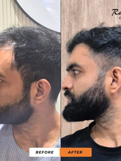 Another angle for the same patient, showcasing the seamless integration of the transplanted hair. The result is a natural profile and a significant boost in hair volume.