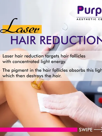 This graphic explains how laser hair reduction works. The laser targets the pigment in the hair follicles, and the light energy is absorbed, which destroys the hair.