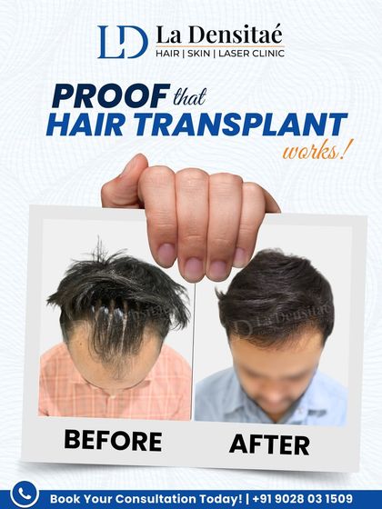 This patient tried to hide his receding hairline, but now he doesn't have to. After placing 2,879 grafts with the RT-FUE technique, his transformation is a testament to patience, planning, and trusting the process.