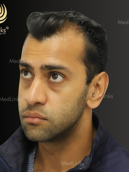 This patient is ready for his transformation. The hair is clipped back to clearly define the treatment area, a crucial step in our precise and methodical hair restoration process.