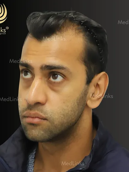 This patient is ready for his transformation. The hair is clipped back to clearly define the treatment area, a crucial step in our precise and methodical hair restoration process.