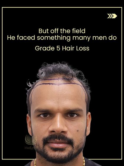 Here we see the hairline marking for Lalit's procedure, a critical step in planning for a natural and effective result for his Grade 5 baldness.