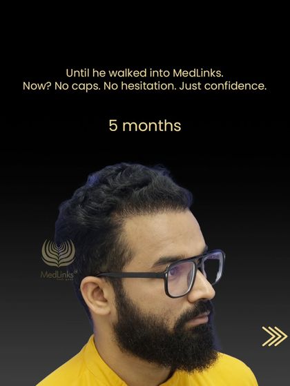 Just 5 months after his procedure, Abhilash no longer needs caps or feels hesitation. His confidence is back.