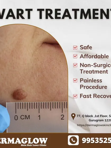 Your safety and comfort are our priority. Our wart removal treatment is a non-surgical and virtually painless procedure that ensures a fast recovery, allowing you to return to your daily life with confidence.
