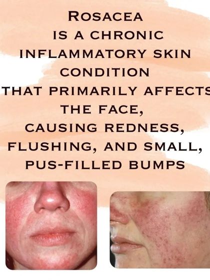 Rosacea is a chronic inflammatory condition that causes facial redness and bumps. Understanding what it is is the first step toward managing it.