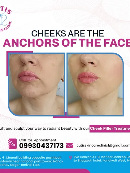 A powerful before-and-after comparison of our cheek filler treatment. This visual clearly shows how restoring volume to the cheeks acts as an anchor for the face, providing a visible lift and reducing sagging.