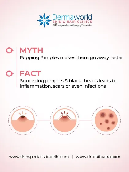 A common myth is that popping a pimple makes it heal faster. The fact is, squeezing pimples pushes bacteria deeper, leading to more inflammation, potential infection, and a higher risk of permanent acne scars.