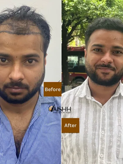 Just 6 months after his procedure for Grade 4 baldness, this patient is enjoying a full head of hair. We used the FUE-DHT technique to ensure maximum graft survival and a dense, natural outcome.