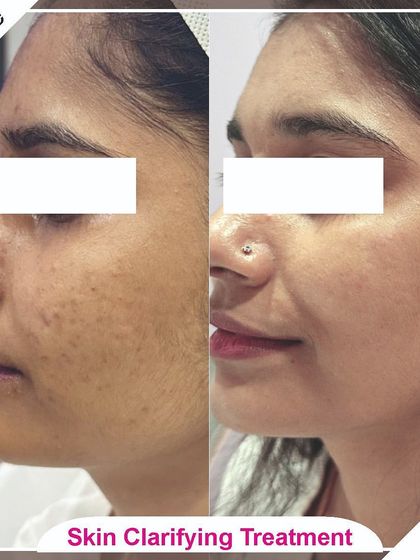 This side view demonstrates the effectiveness of our skin clarifying treatments in evening out skin tone and texture.