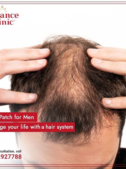This image shows advanced hair thinning, a situation where a custom hair system can completely change your life. My goal is to give you a look you are proud of.