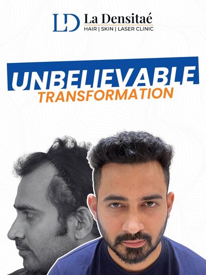 This before-and-after collage highlights an incredible transformation. From hair loss struggles to a confident new look, this is a clear example of what my expert care and precision techniques can deliver.