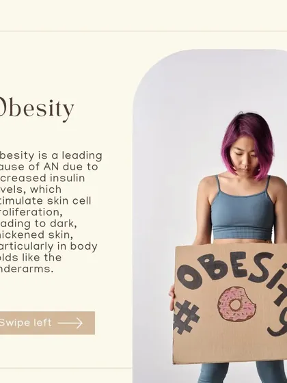 Obesity can be a leading cause of AN due to increased insulin levels, which stimulate skin cell proliferation. This leads to dark, thickened skin, particularly in body folds like the underarms.